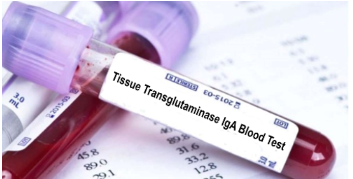 haberler Doku Transglutaminaz IgA (Anti-tTG IgA) Testi